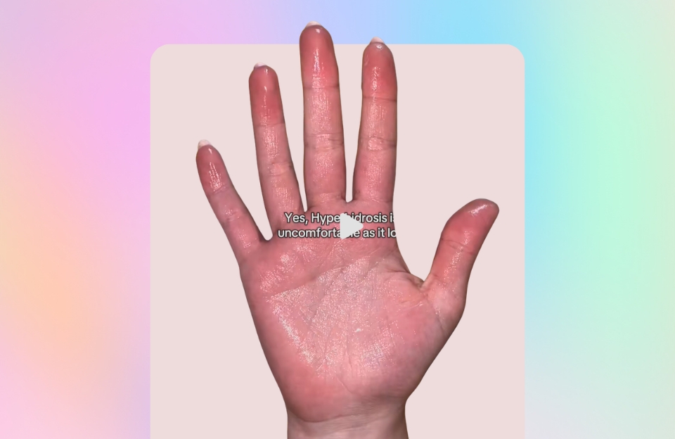 Hand with palmar hyperhidrosis (excessive sweating)